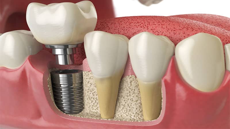 À quoi s'attendre au cours d'une procédure d'implant dentaire - CDP