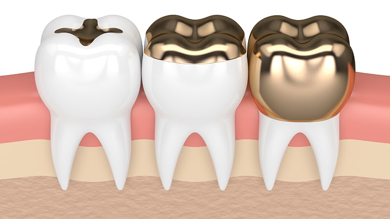 couronnes temporaires,100PCS dent provisoire, couronne molaire antérieure,  couronne résistante de dents de différentes tailles, dent temporaire, dents